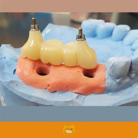 ZIRCONIA IMPLANT BRIDGE (3 UNITS) – Dental Digital Crown