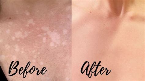 how to cure tinea versicolor at home