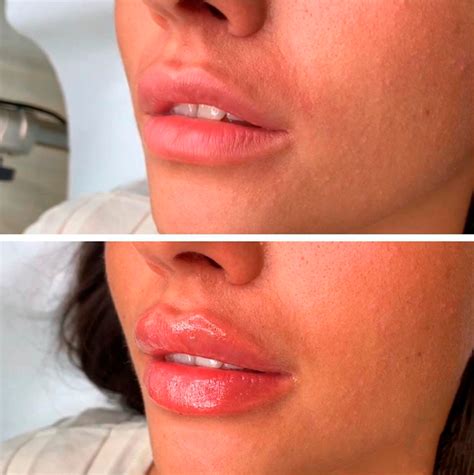 Филлер Allergan Juvederm Ultra 3, 1 мл купить в интернет-магазине цена ...