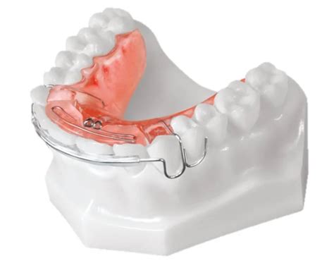 What is a Hawley Retainer