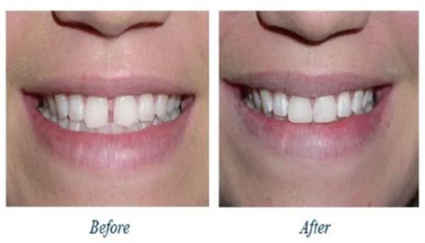 Bridging the Gap: Exploring Effective Teeth Gap Treatment in Nerul | Medium