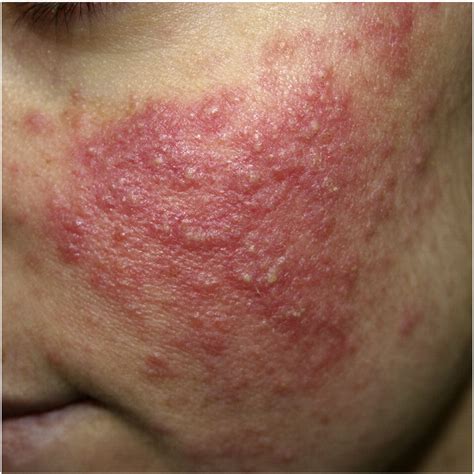 Rosacea and rhinophyma - Clinics in Dermatology