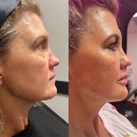 RHA Fillers in Lebanon | Restoration Wellness and Medspa