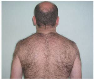 Hypertrichosis - Pictures, Causes and Treatment