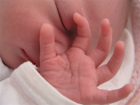 Birth Injuries Common in New York City