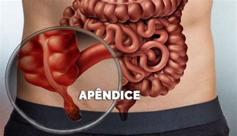 Onde Fica O Apêndice – Apêndice: onde fica, o que é, função, anatomia ...