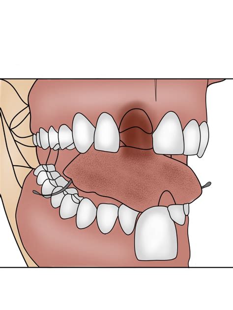 Flipper Tooth Replacement
