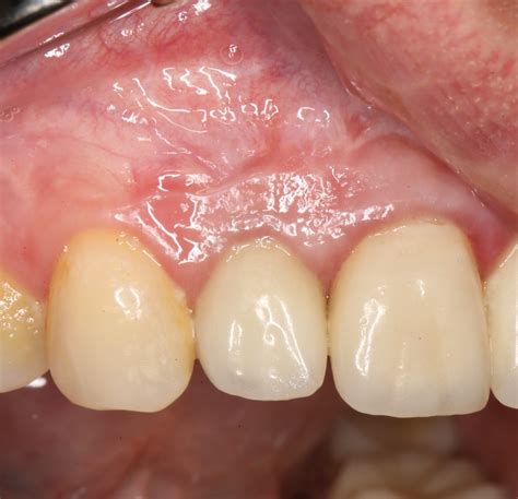 Куда уходит костный блок? — IMPLANT-IN.COM — дентальная имплантация ...