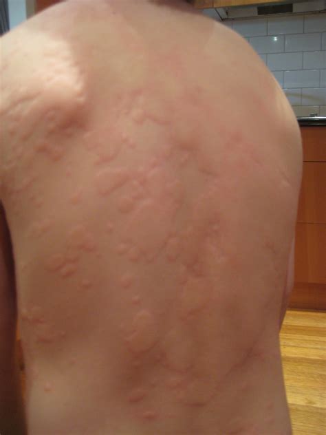 urticarial rash