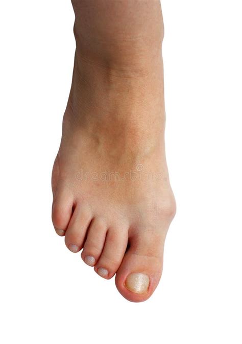 Medetcin, Valgus Bunion, Leg with Deformity Valgus Hallux Bunion, Stock ...