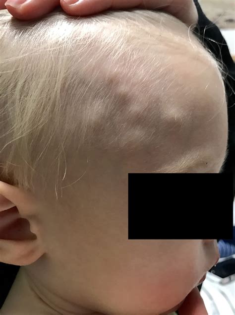 Granuloma Annulare Face