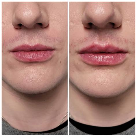 Lip Filler | Drew & Co Medical Aesthetics | Kenosha, WI