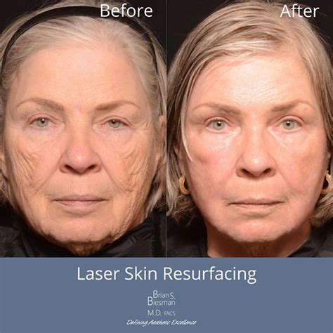 laser skin resurfacing cost  james reis blog
