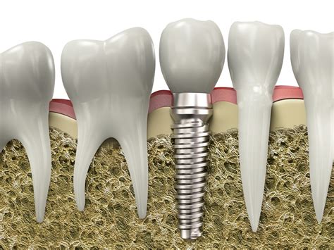 5 Reasons Why Dental Implants Have Become So Popular! - Banff Dental Care