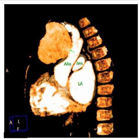 AV fistula aneurysm repair-a) the aneurysm as was typically found at ...