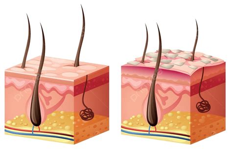 Human Skin Diagram With Normal And Psoriasis Anatomy Science Image ...