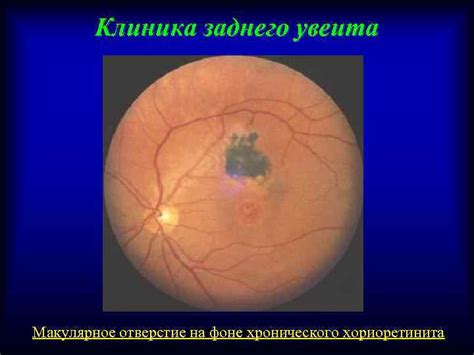 Увеиты современные проблемы молодой