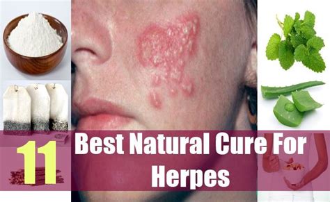 get rid of herpes naturally – The Only Cure For Herpes That Works