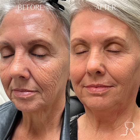 laser skin resurfacing  afters