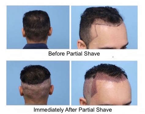 Shaving Before FUE Transplant - Parsa Mohebi Hair Restoration