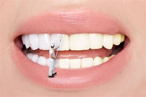 veneers