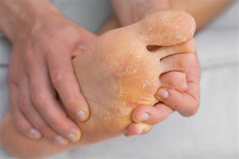 Causes of Yellow Toenails – Fungus Therapy – fungustherapy.com