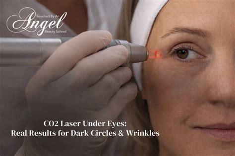 laser  eyes cost safety  real results  dark circles