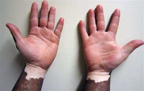 Vitiligo: qué es y cómo se trata