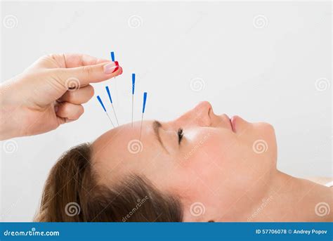 young woman receiving acupuncture treatment stock photo image