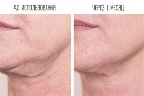 Лицевой корсет S-Slim || Бандаж маска для лица купить