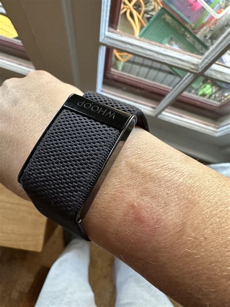 Sudden hot skin burn : r/whoop