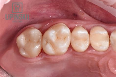 Composite restoration