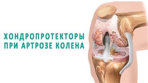 Эффективны ли хондропротекторы при артрозе коленного сустава? - YouTube