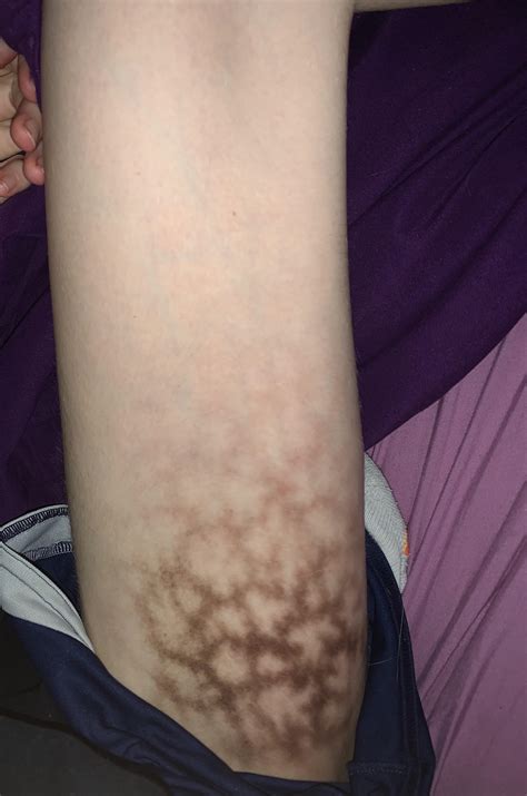 Blue Line On Leg at John Tabarez blog