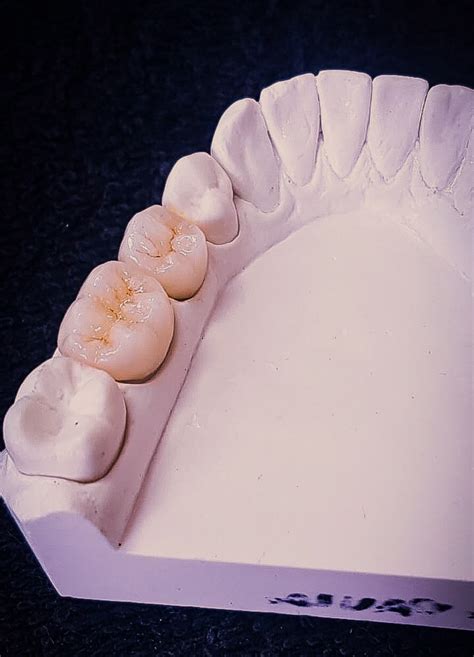 Prótese Dentária | Diego Alonso