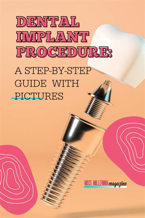 Dental Implant Procedure: A Step-by-Step Guide With Pictures