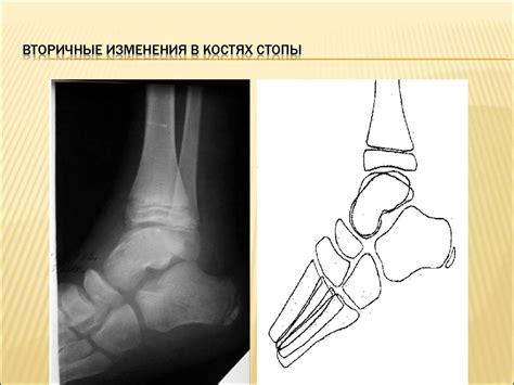 Плоскостопие. Виды плоскостопия - презентация онлайн