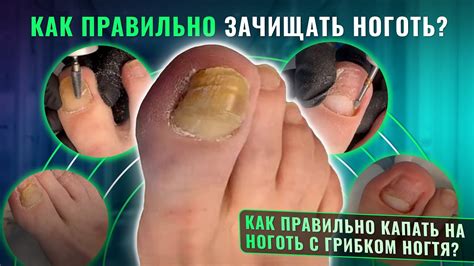 Как правильно зачищать ноготь? Как правильно капать на ноготь с грибком ...