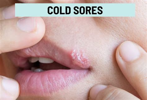 how to know if it's a pimple or cold sore