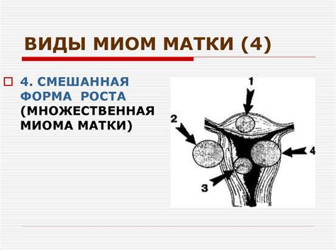 Миома матки - презентация онлайн