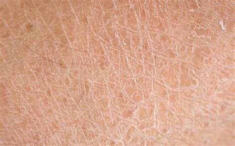 Ichthyosis Cure: Breakthrough Treatment Options and Remedies - Summers ...