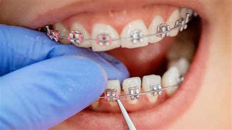 How To Put Wax On Braces? How to Handle Common Issues?