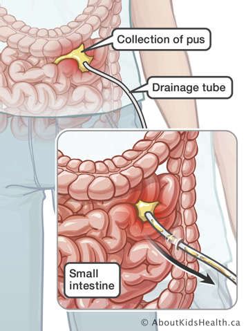 abscess drainage  image guidance