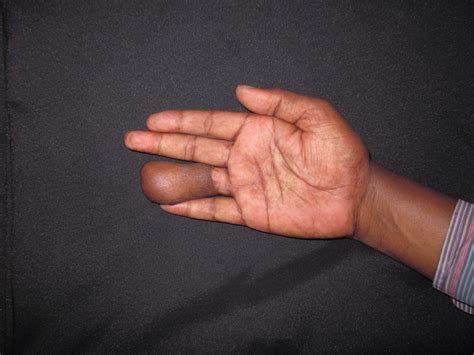 RING AVULSION INJURY RIGHT RING FINGER - GROIN FLAP COVERAGE - HAND ...