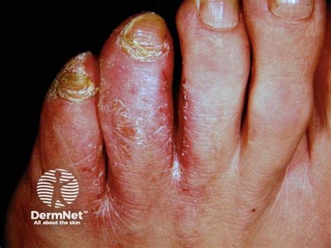 tinea pedis skin peelings typical  fungi tinea pedis tinea
