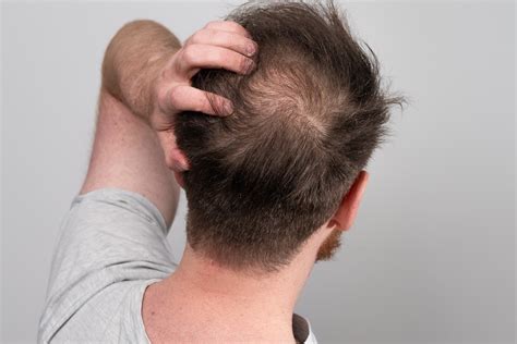 Early Hair Thinning in Men: Signs, Causes & When to Seek Help | SPRINGS ...