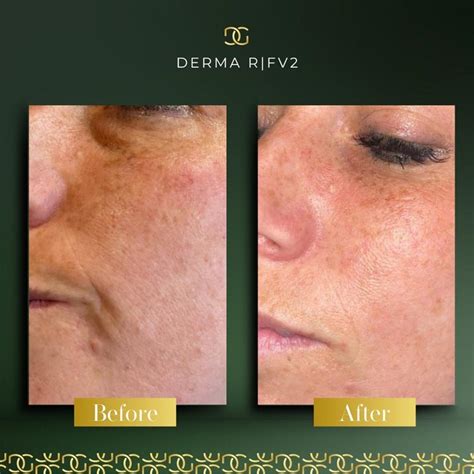 Derma Radio Frequency R|F V2 | Derma Group Ltd