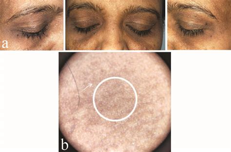 clinical image  nevus  ota  left side  face  dermoscopic