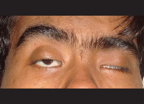 Blepharophimosis Ptosis Epicanthus Inversus Syndrome Or Bpes