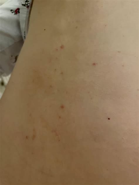 Does this look like scabies? : r/scabies